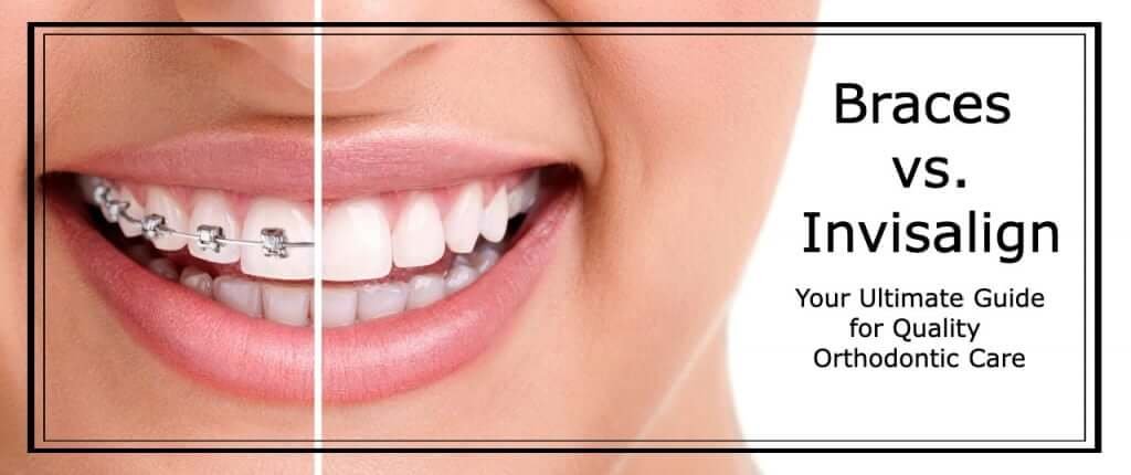 Invisalign vs Braces: Which is Better For You? - Antalya Dental Clinic