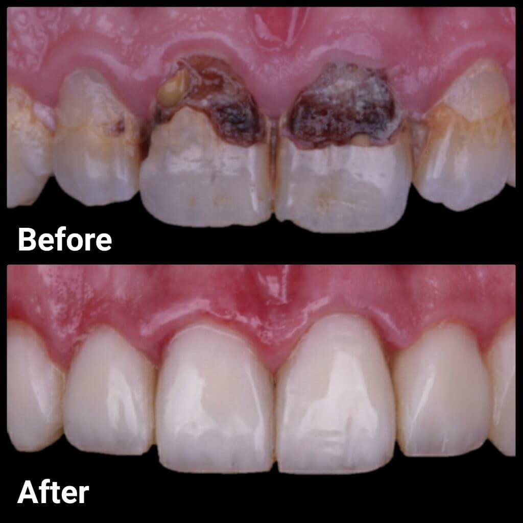 Composite Resin Veneers