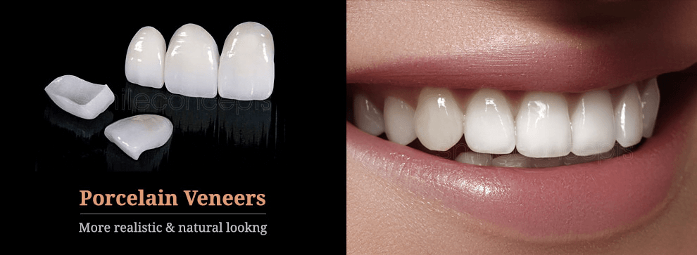 Porcelain Veneers