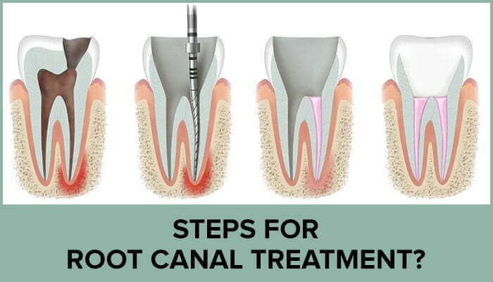 dental-root-canal-treatment-endodontic-in-malaysia-dental-home