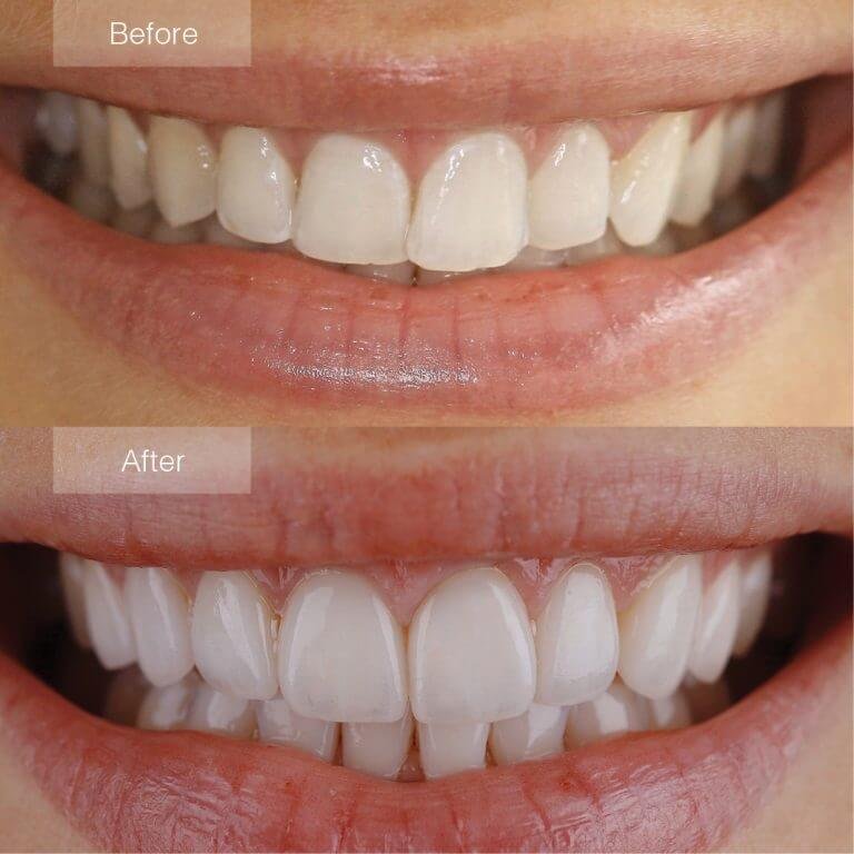 Veneer treatment at Dental Home clinic in Malaysia