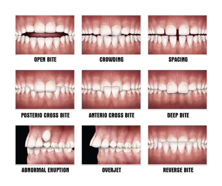 Achieve a Confident Smile with Our Expert Braces Dentist - Dental Home