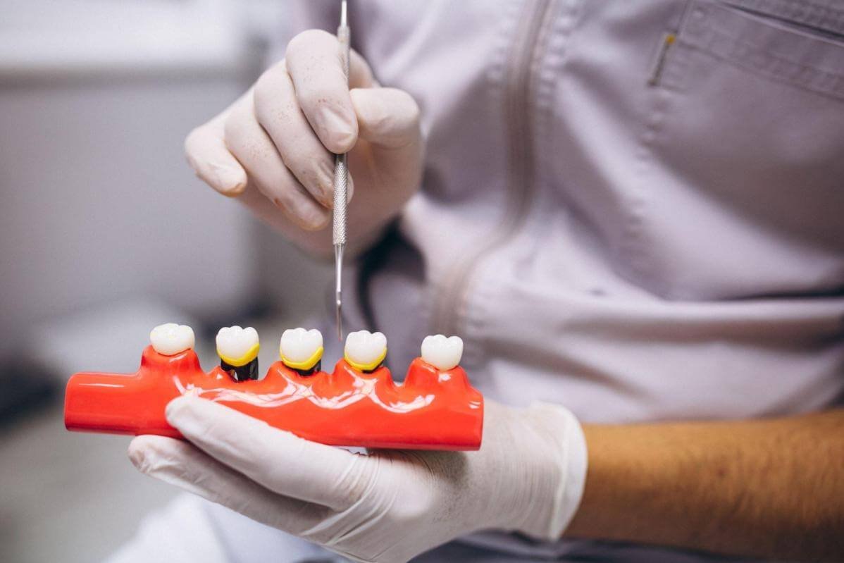 Selecting The Right Kind Of Veneers