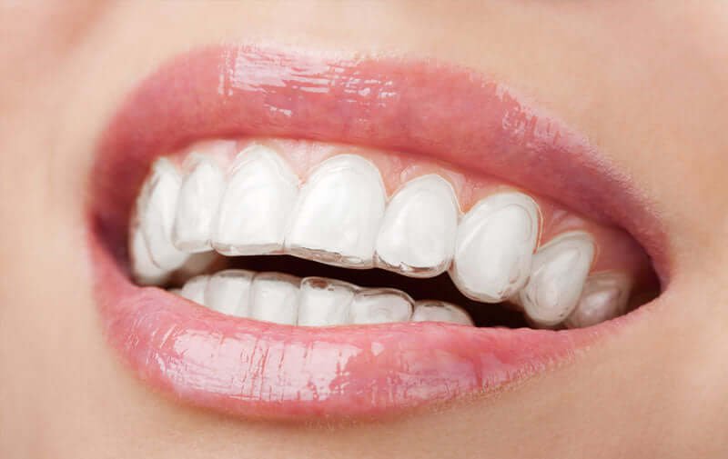 invisalign braces dental home dental clinic