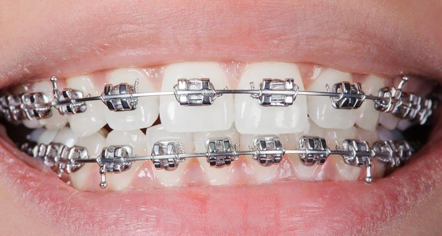 metal braces dental home dental clinic