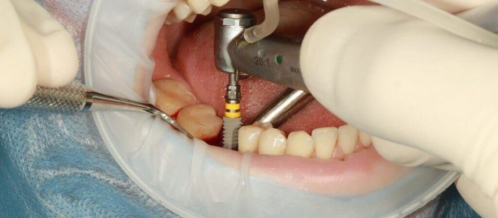 dental implant procedure dental home dental clinic