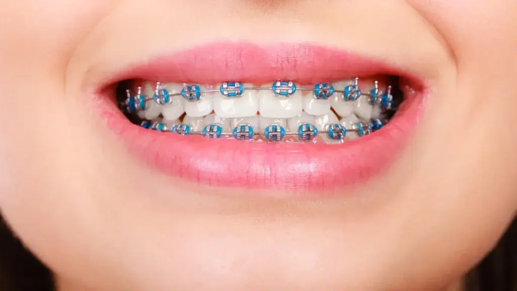 braces prices dream smile dental home