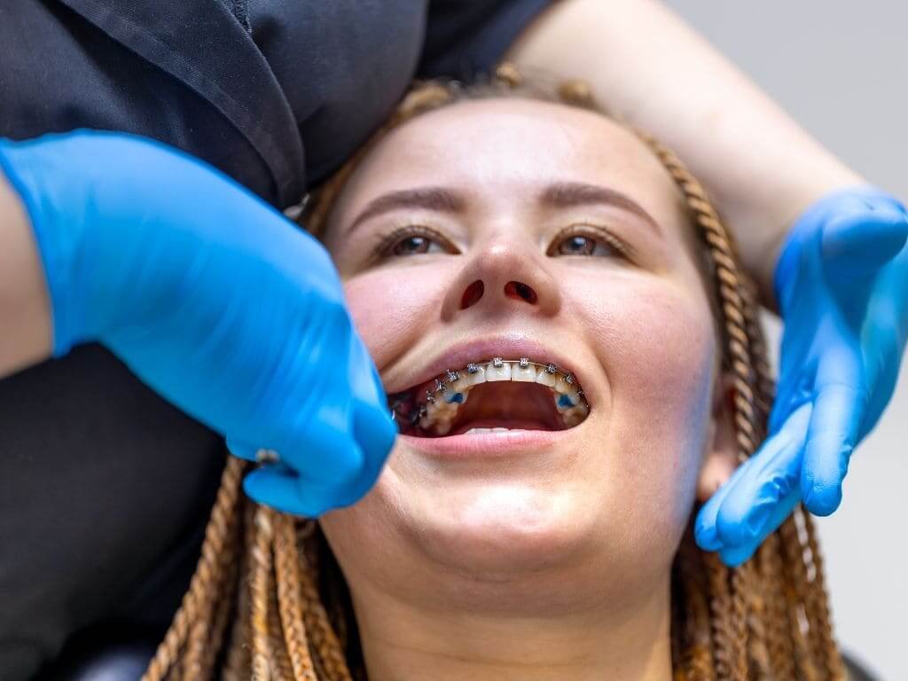 Do I Need Braces for an Overbite? | Dental Home