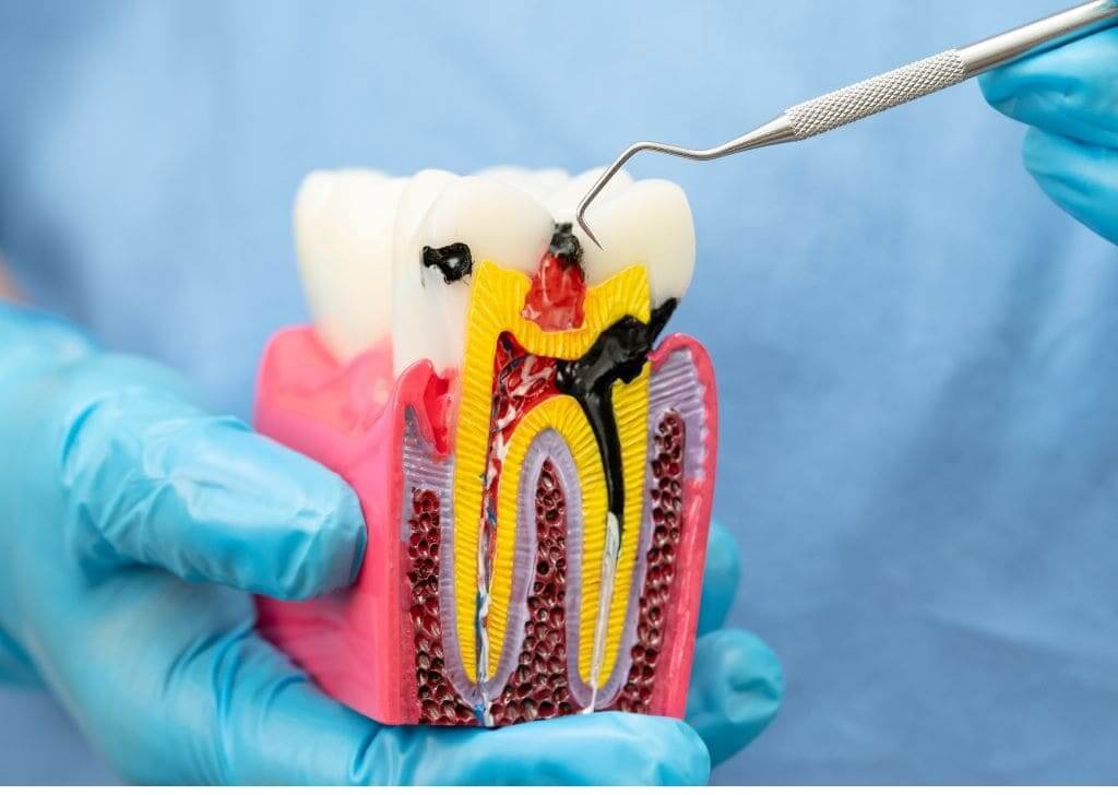 Root Canal Treatment Still Hurts? Here Are 5 Tips to Ease the Pain at Home.