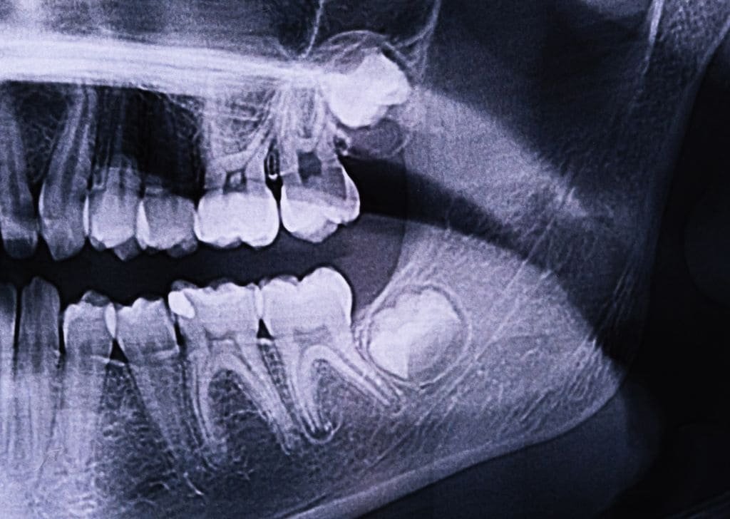 X-ray of potential swelling caused by wisdom teeth.