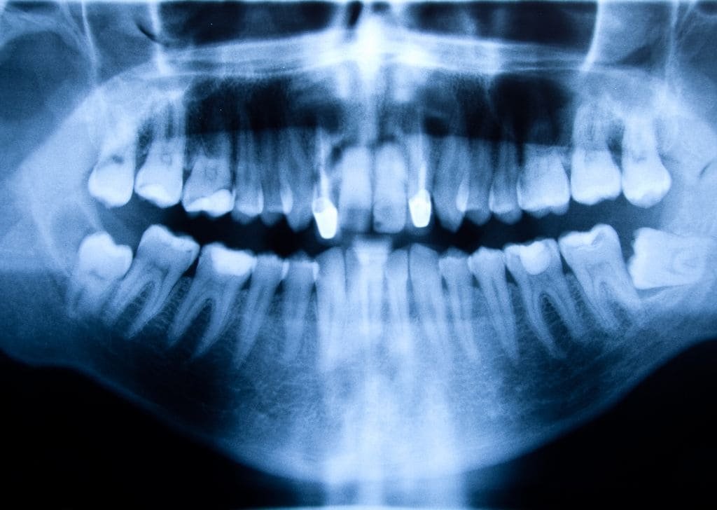 X-ray of teeth at a dentist to check for wisdom teeth eruption.