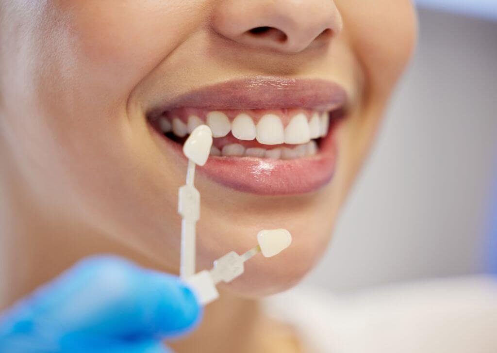 Veneers