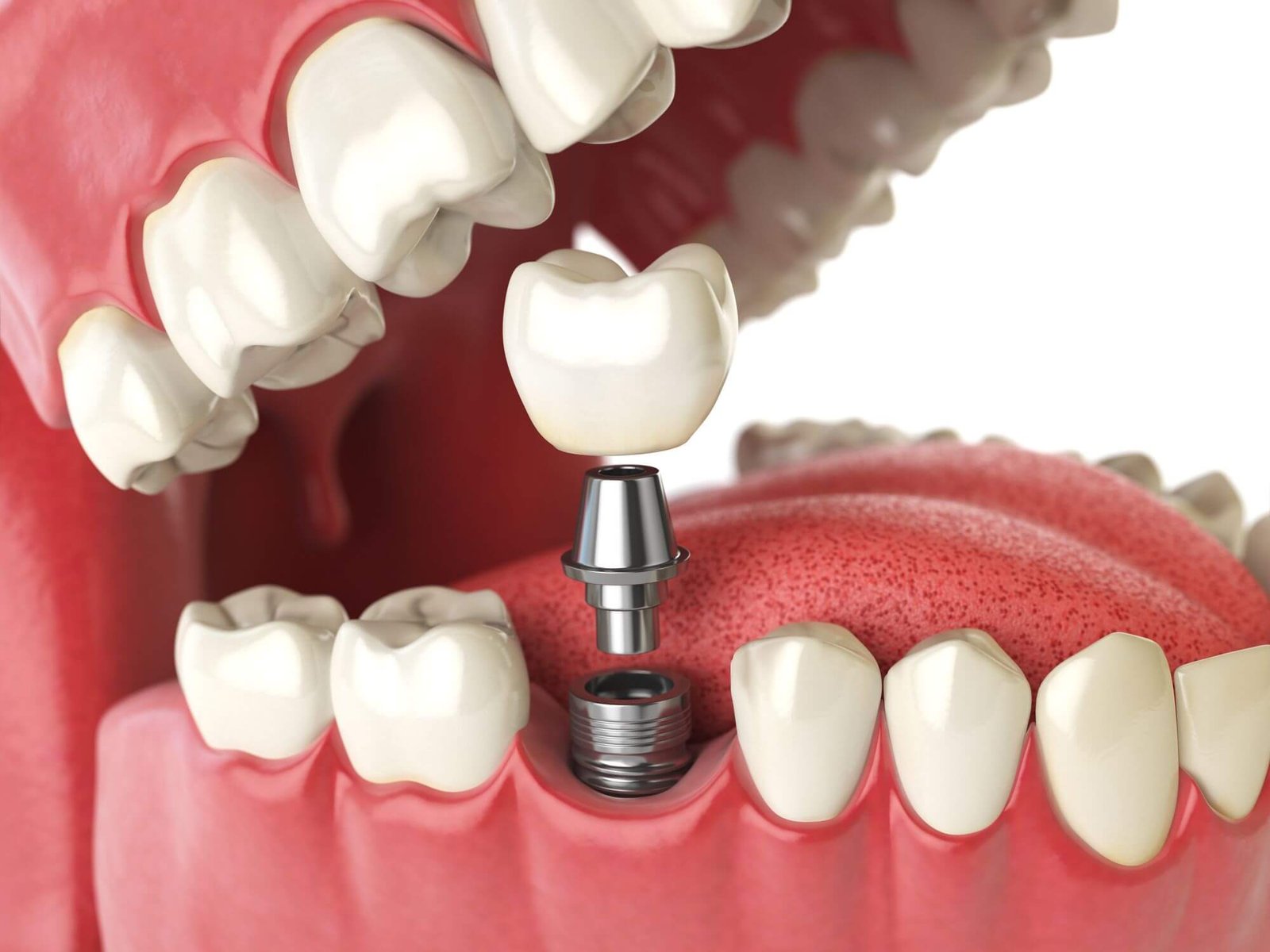Dental Implants3