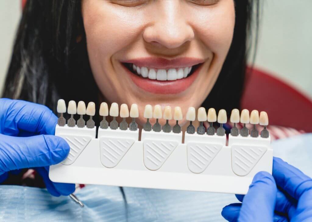 Veneers