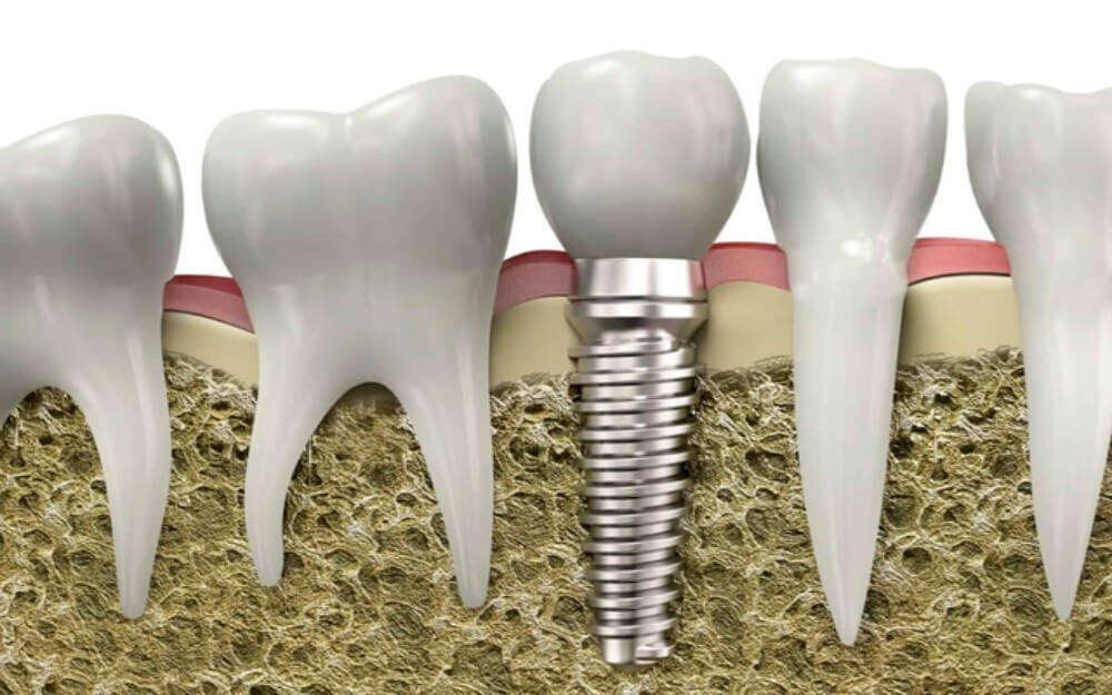 the cost of dental implants