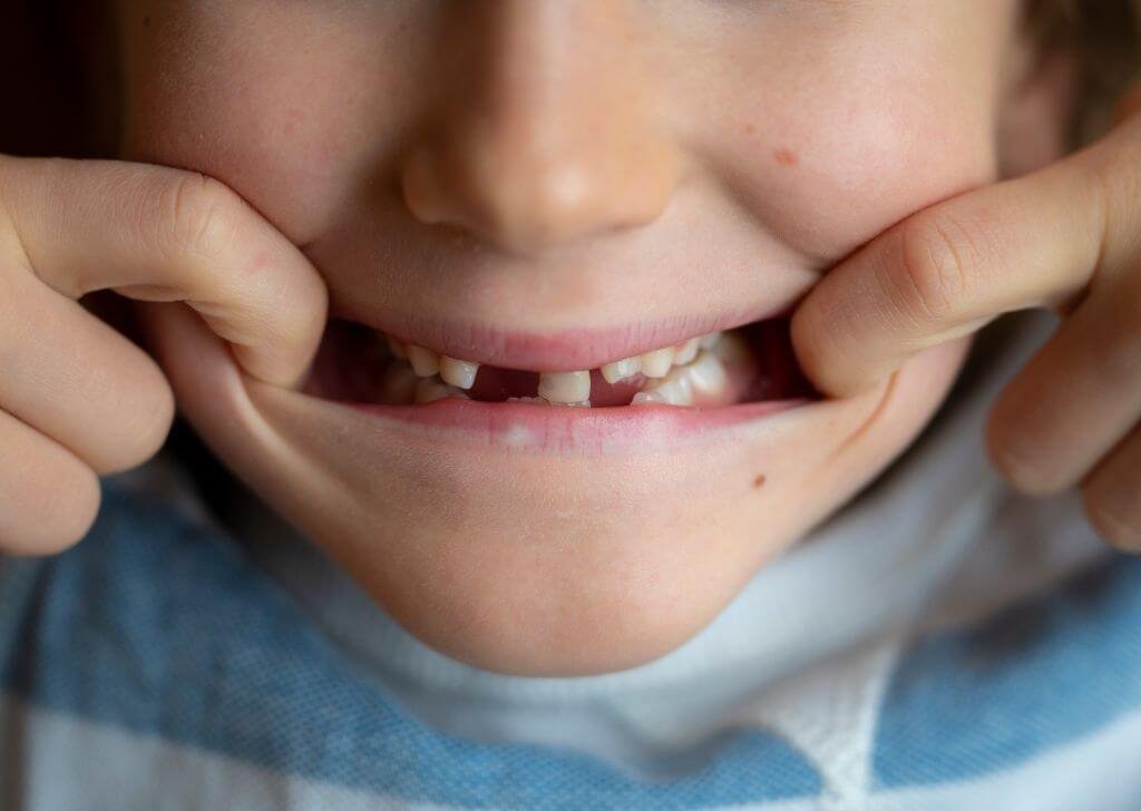 Punca gigi budak cepat rosak.