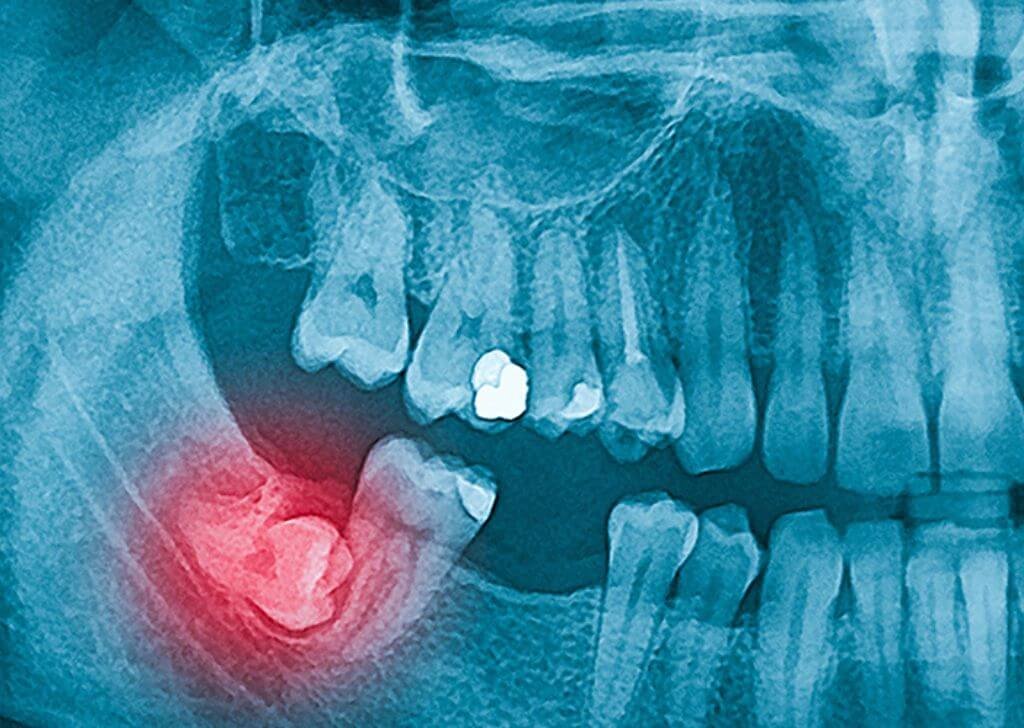 3 X-ray gigi bongsu tumbuh