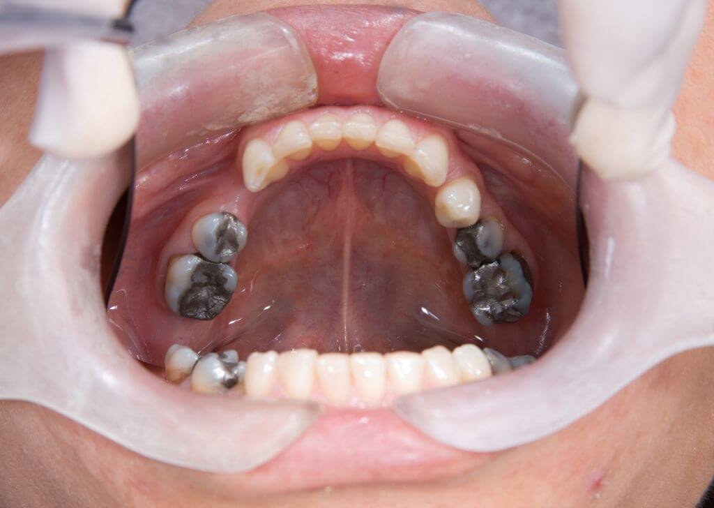 4 Gigi rasa berdenyut itu simptom gigi bongsu tumbuh.