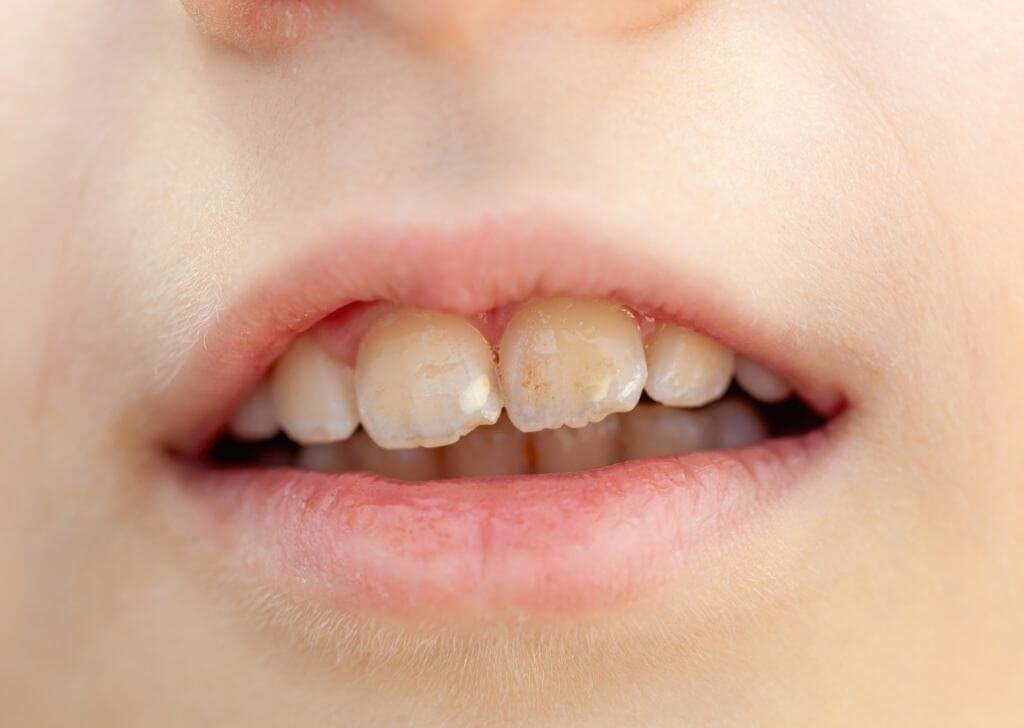 Gigi budak dah bermula rosak