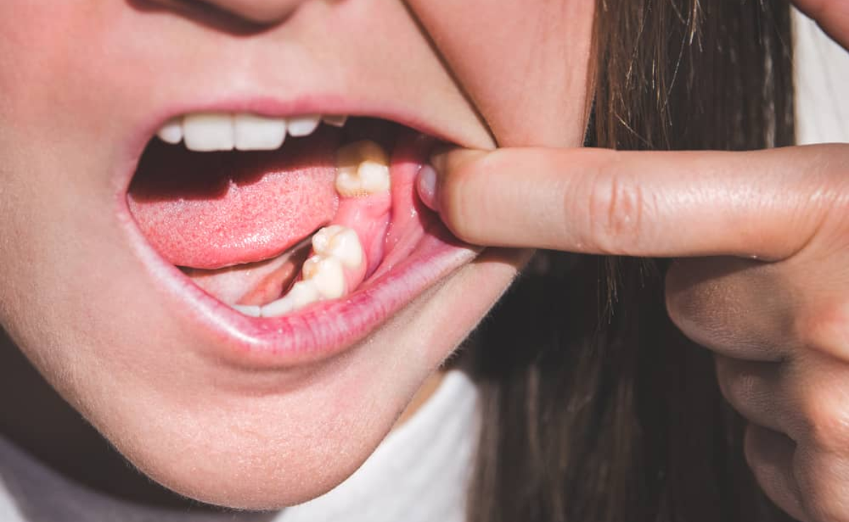 Cabut Gigi Geraham Bawah