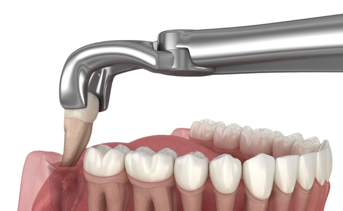 2 Cabut Gigi geraham melalui pembedahan