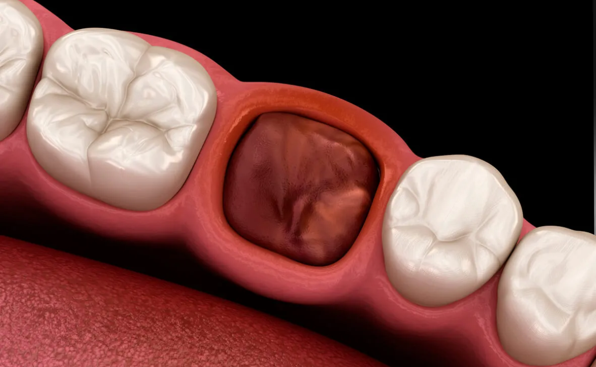 4 Dry socket ( alveolar osteitis )