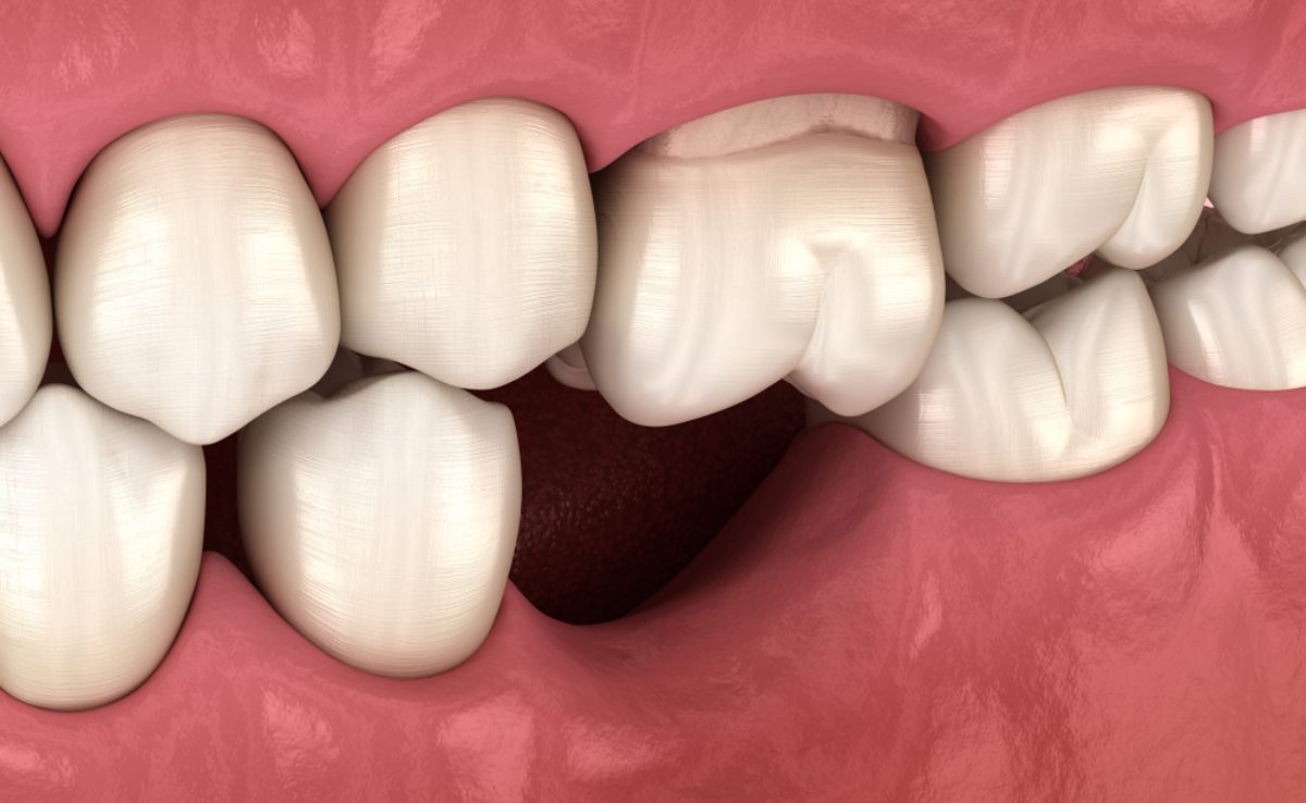 5 Gigi Atas Turn Ke Bawah