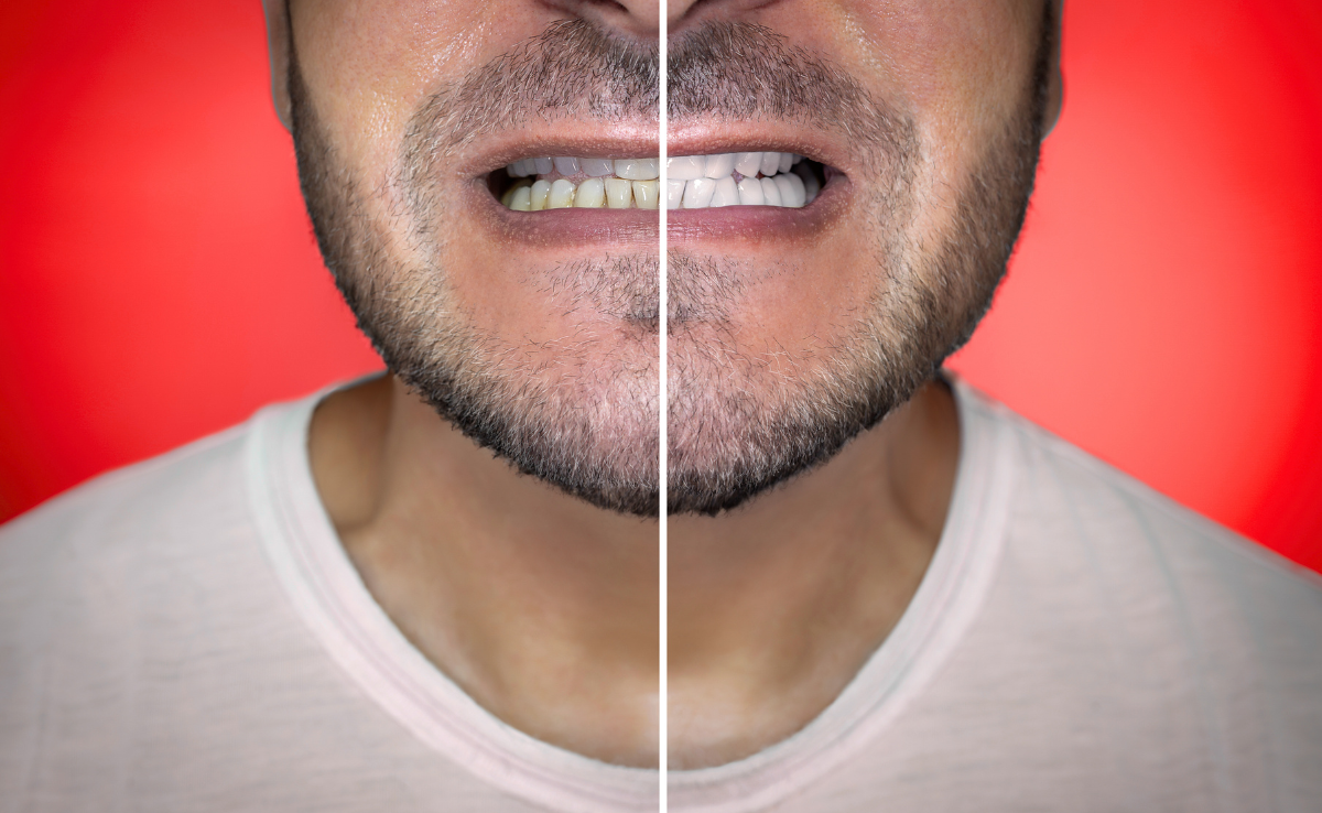 6 Teeth whitening before and after